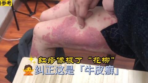 曾以为自己染 花柳 医生必须纠正 这是 牛皮癣 皮损 哔哩哔哩 曾以为自己染 花柳 医生必须纠正 这是 牛皮癣 皮损 哔哩哔哩