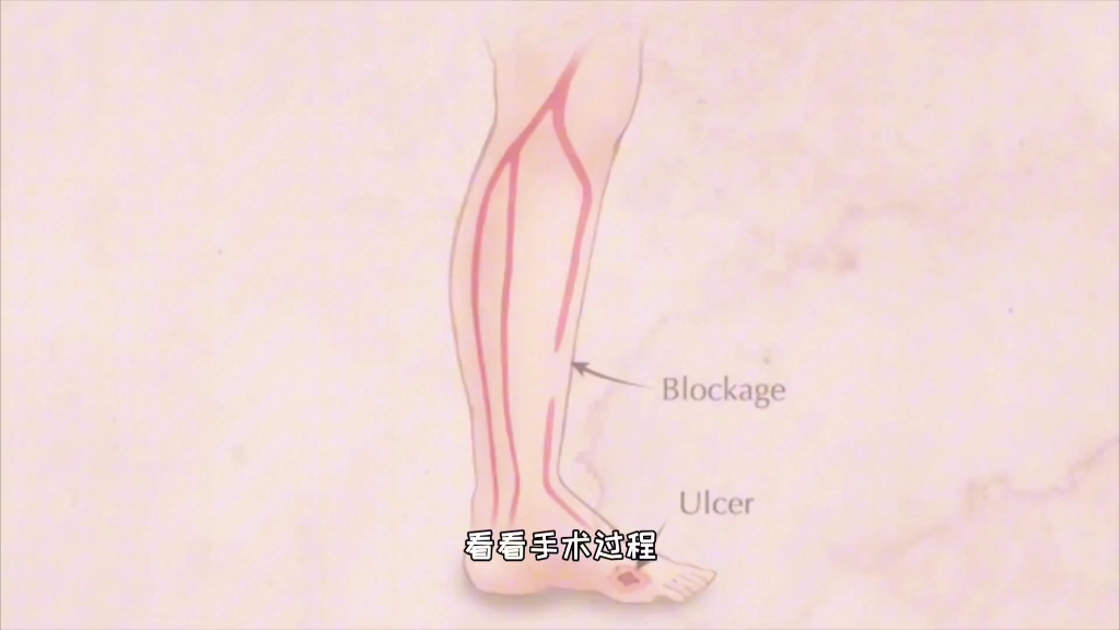 下肢动脉闭塞微创介入治疗,3D演示..哔哩哔哩bilibili
