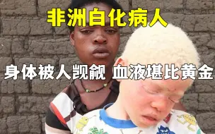 Download Video: 白化病人堪称非洲版“唐僧”，身体被人觊觎，血液堪比黄金。