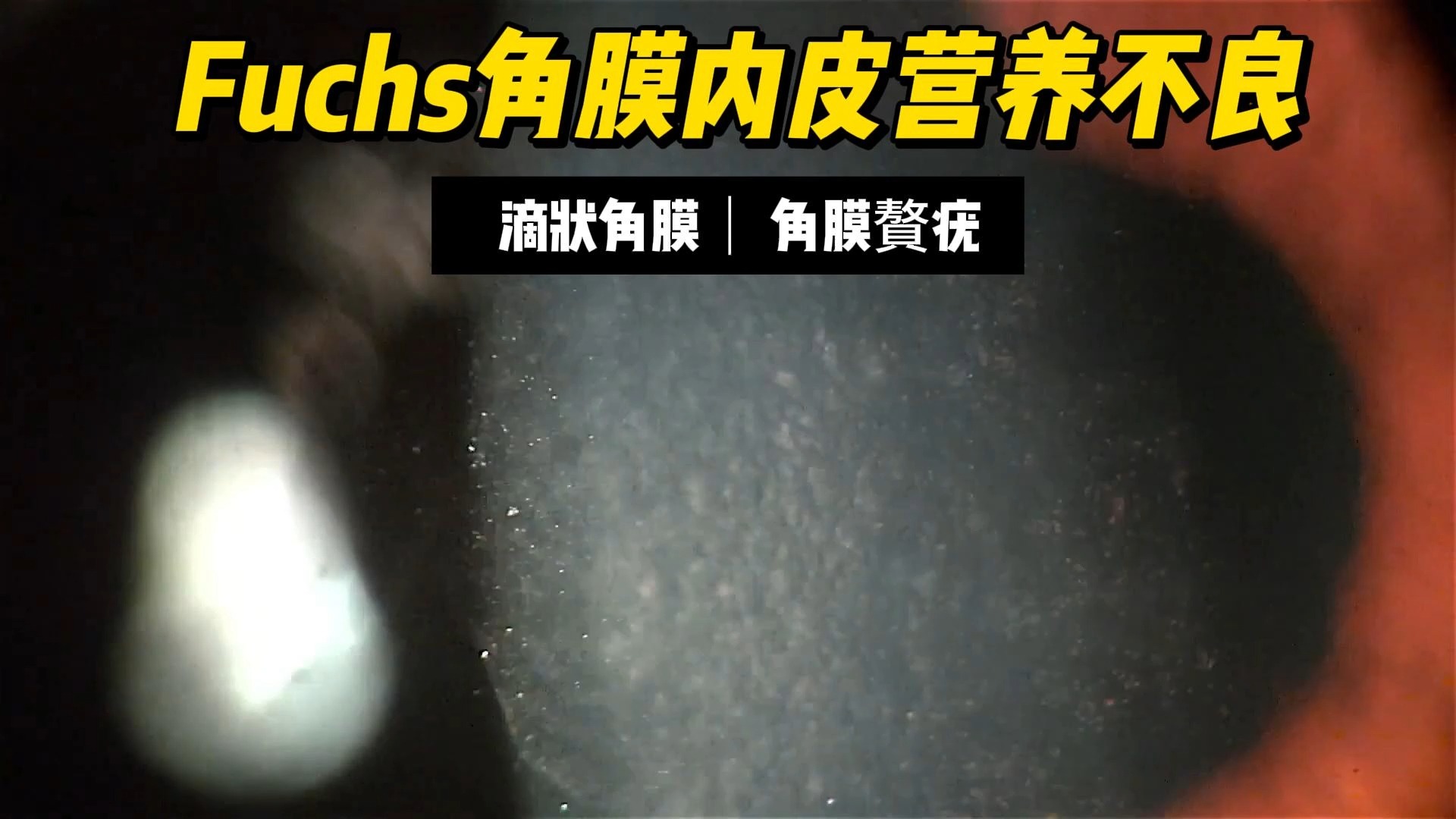 【Fuchs角膜内皮营养不良/滴状赘疣】Fuchs endothelial dystrophy/Cornea guttata哔哩哔哩bilibili