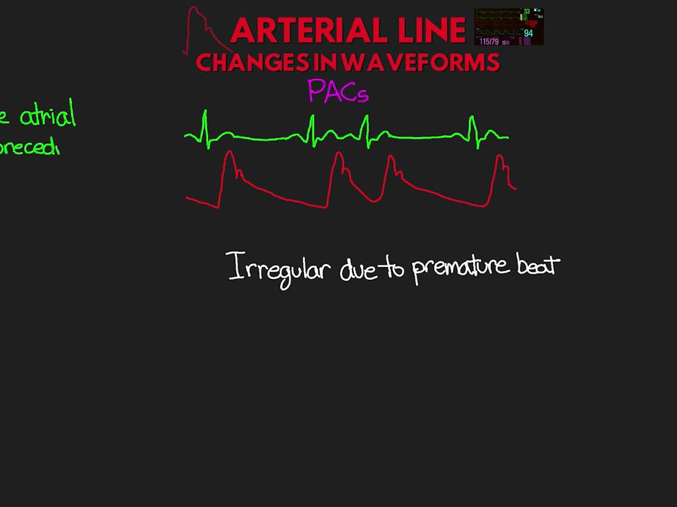 [图]Common Changes in Arterial Line Waveforms