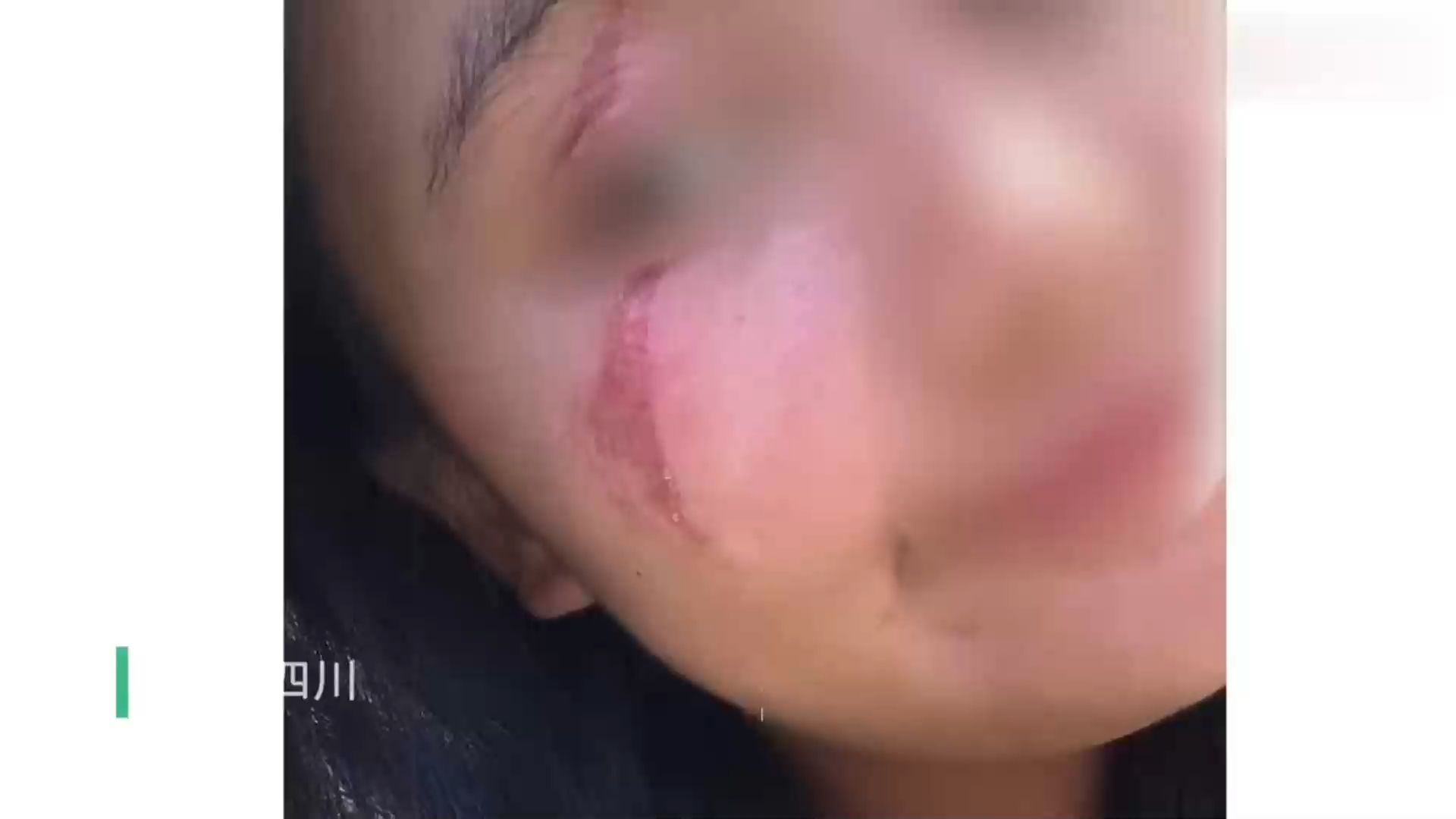 女生躺床上玩手机无意拍死隐翅虫 致面部遭灼伤出现大片伤痕