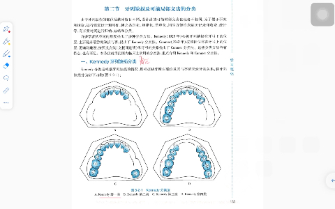 肯氏分类/Kennedy分类(口腔修复学)哔哩哔哩bilibili