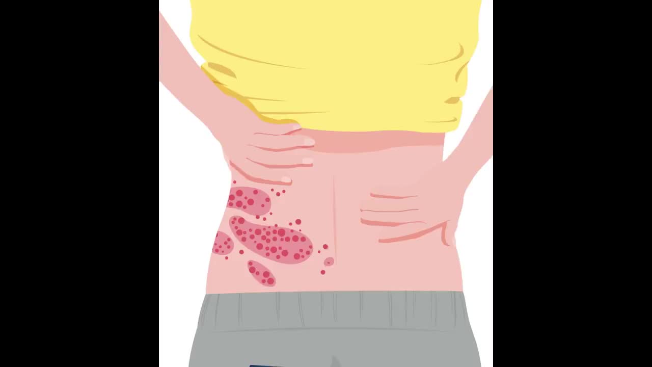 "缠腰龙"有疫苗了!7月起京沪市民可接种