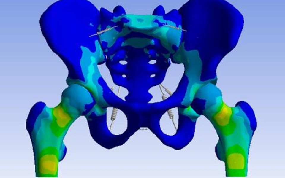 [图]骨盆-生物力学4（ANSYS力学分析软件讲解）