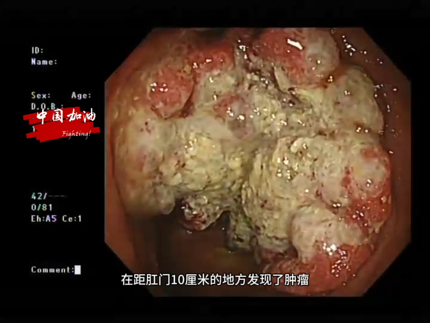 发现直肠高级别瘤变(癌变)2年,一直拒绝治疗,现在肿瘤大了整整一倍,而且目测浸润更深了.哔哩哔哩bilibili