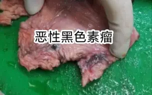 Download Video: 见过特殊部位的恶性黑色素瘤吗？一例来自女性生殖系统的恶黑！