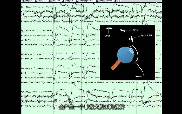 04.脑电图0基础  脑电图4种常见模式哔哩哔哩bilibili