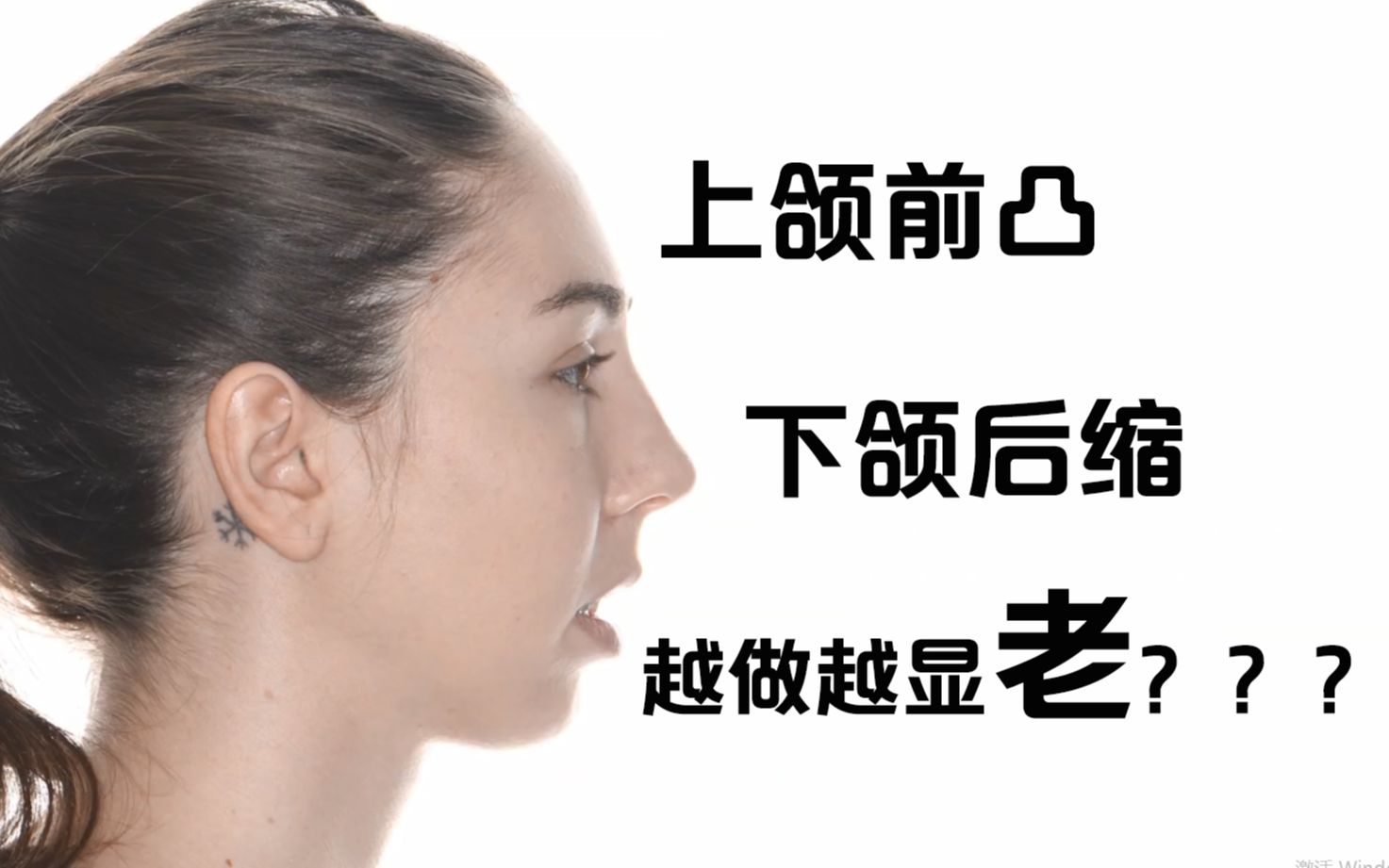 骨性上颌前凸下颌后缩带牙套也没用双鄂后反而更显