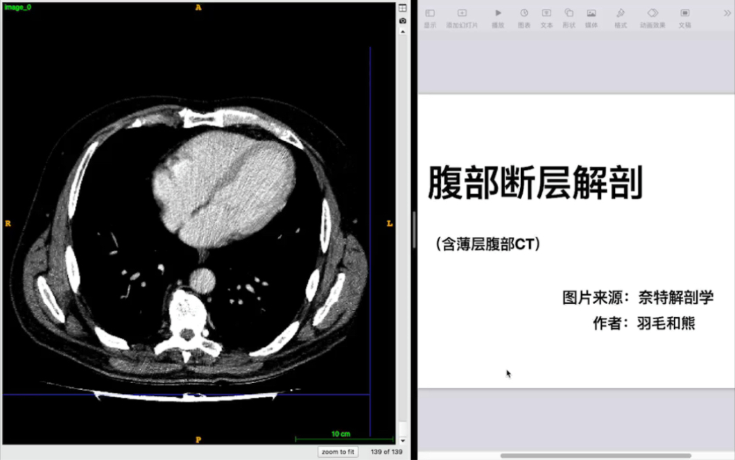 [图]详细分解腹部断层解剖(腹部CT)