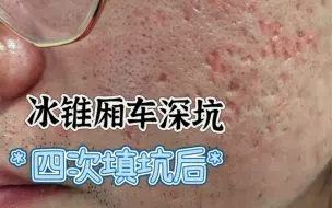 Download Video: 痘坑修复，4次综合激光后，感觉恢复了80%？