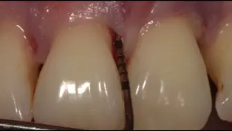 牙龈下面洗不到的牙结石，要翻开牙龈后在进行洗牙，你能接受吗？