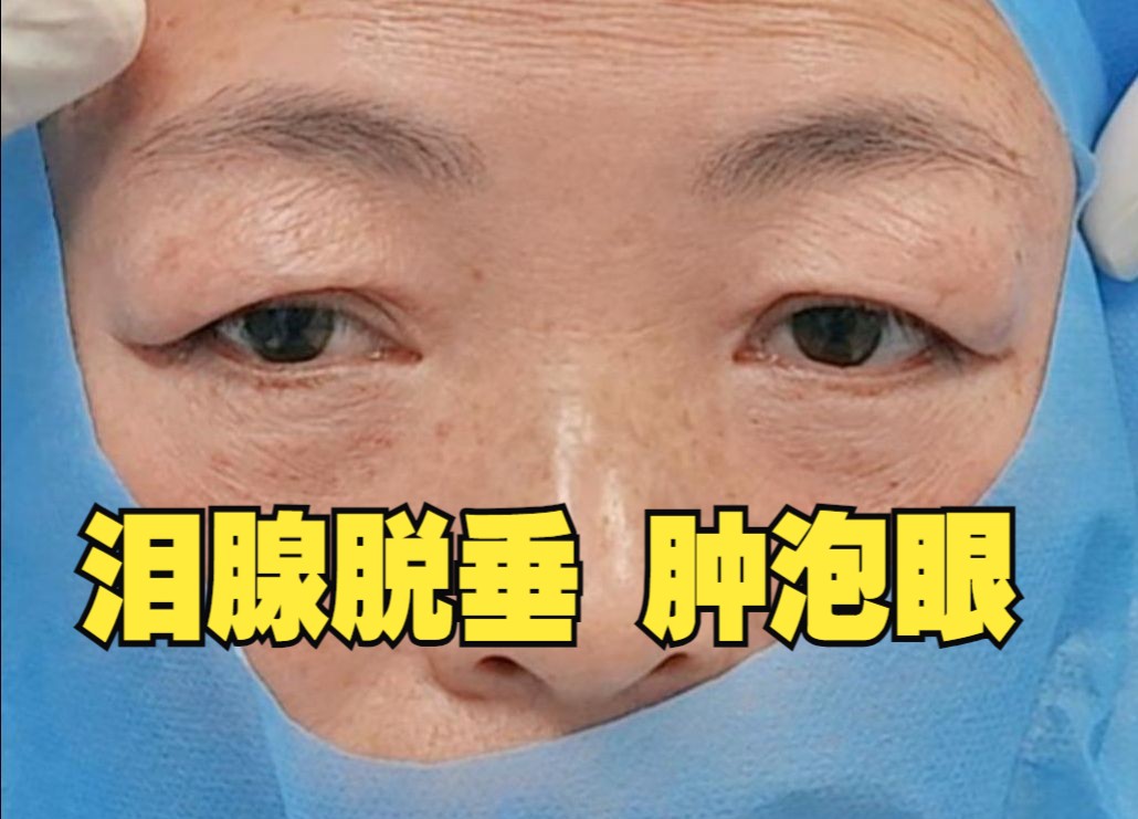 双眼皮术前分析:泪腺脱垂 ,皮松下耷的肿泡眼怎么改善?