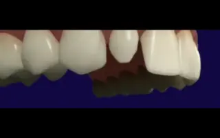 牙齿短小不美观，要怎么修复好呢？漳州烤瓷牙