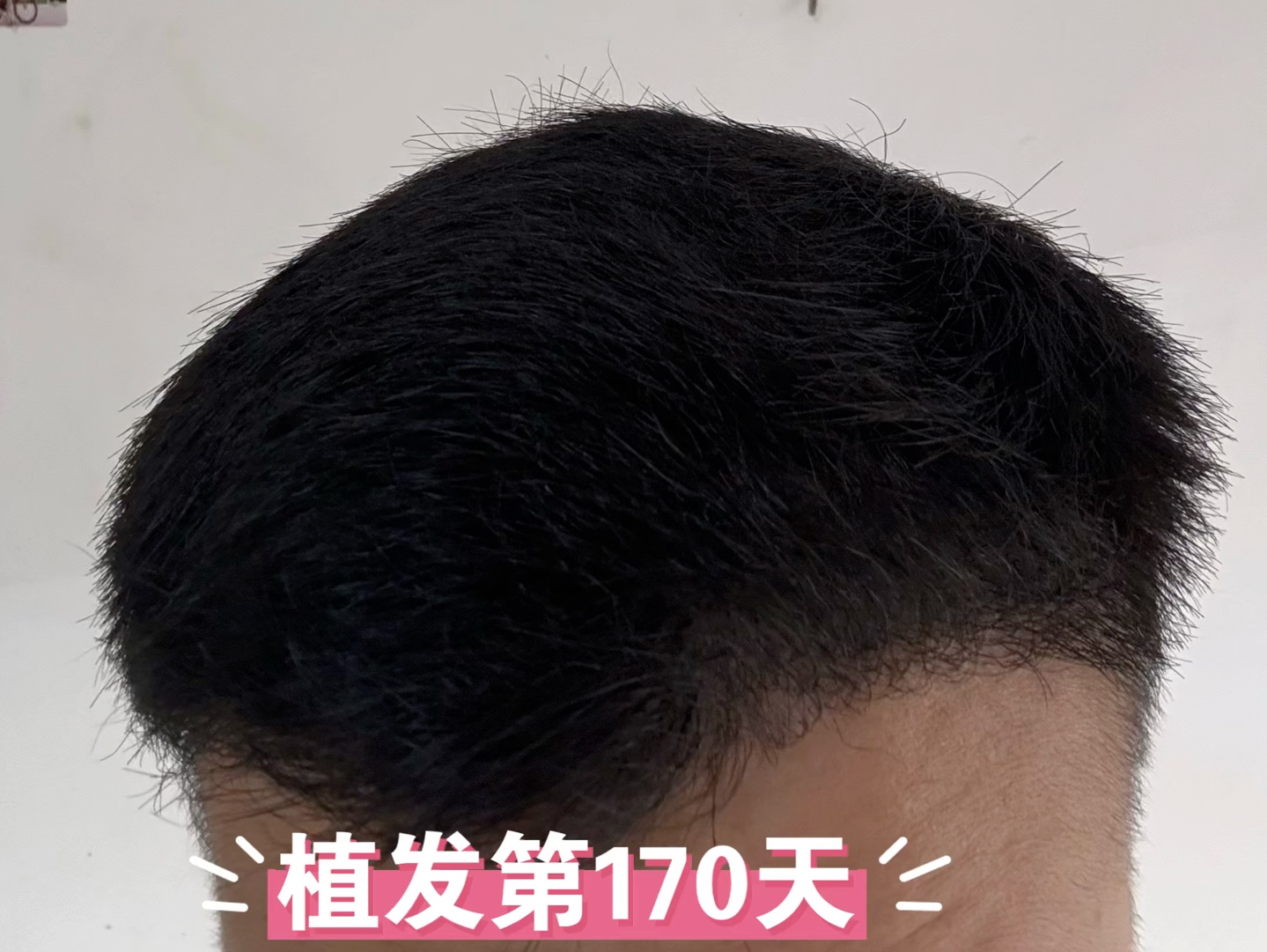 植发外包(植发机构可信吗)