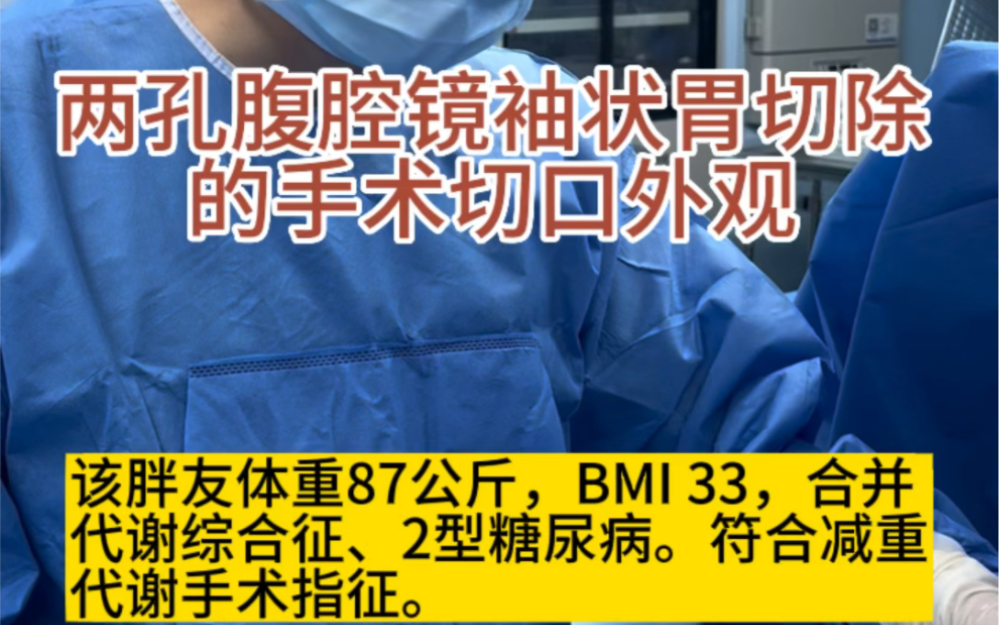 两孔腹腔镜袖状胃切除的手术切口外观.哔哩哔哩bilibili