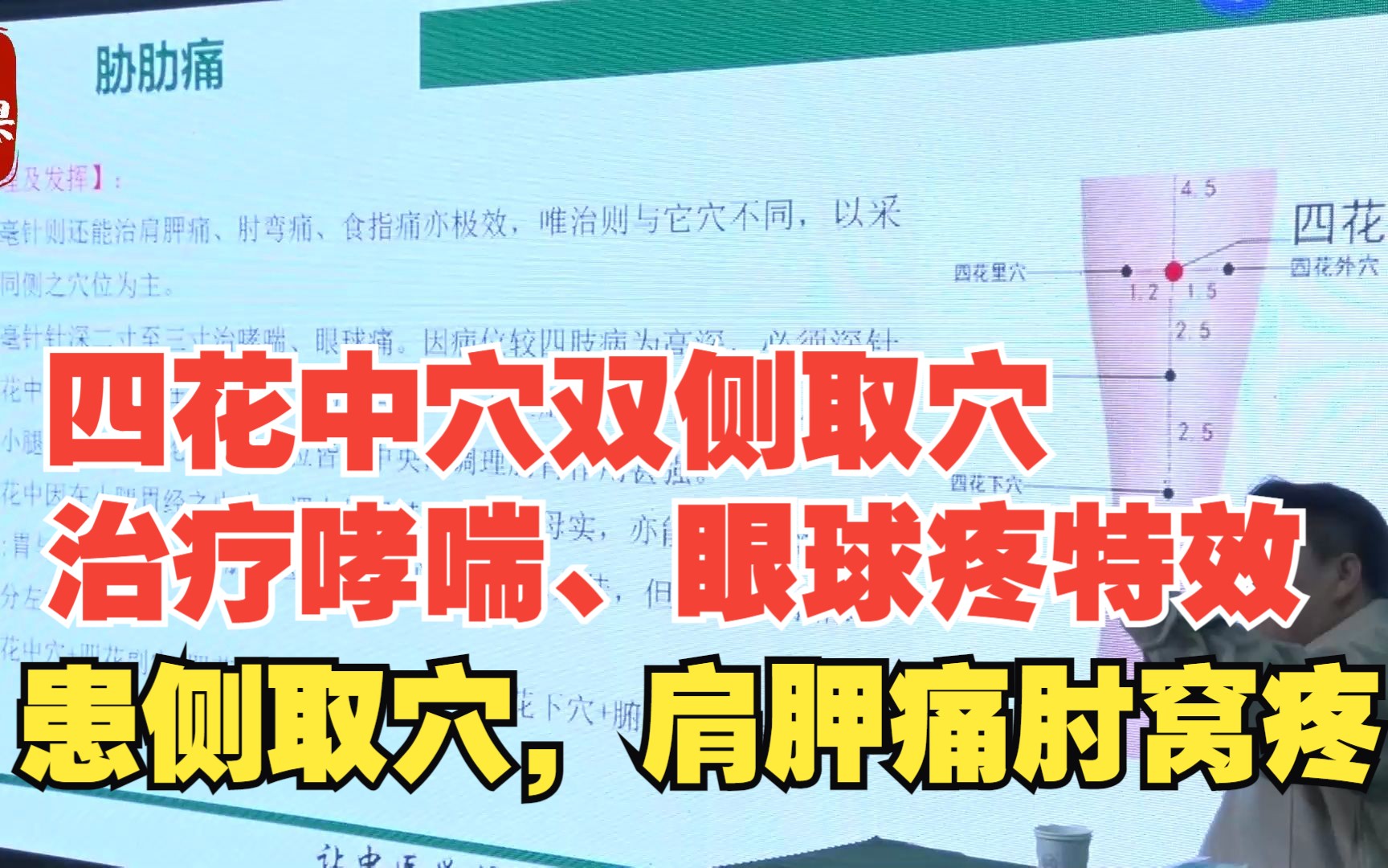 四花中穴双侧取穴治疗哮喘、眼球疼特效,患侧取穴,肩胛痛肘窝疼哔哩哔哩bilibili