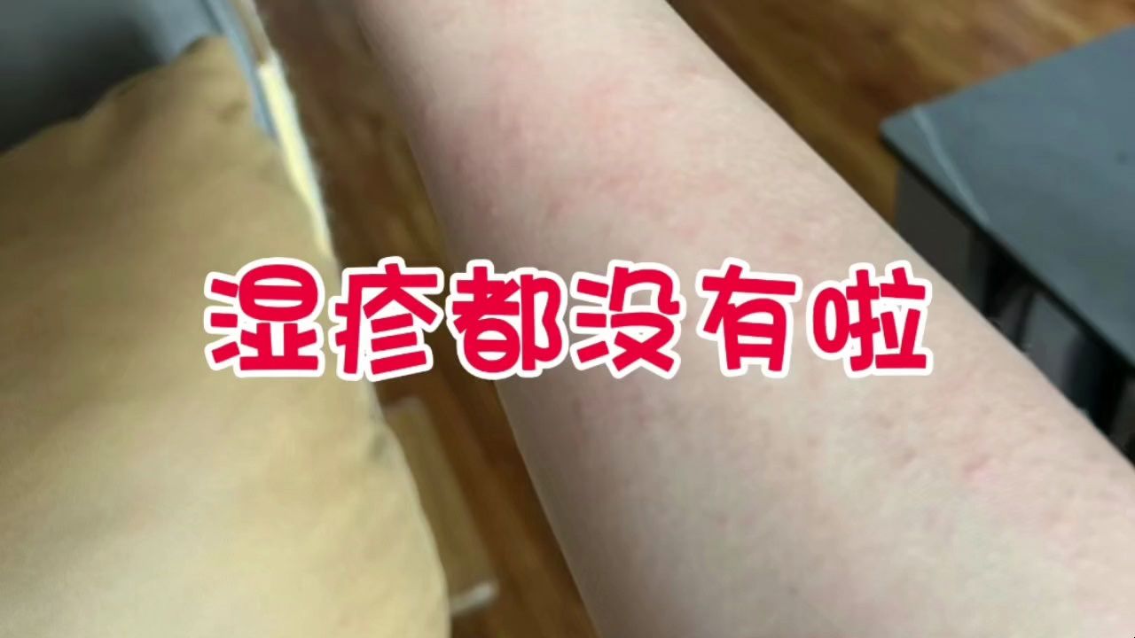 万万没想到!皮炎湿疹真的好了!