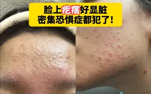 Tải video: 【科普】董妈知道长闭口真的很显脸脏、皮肤差，但你们也别瞎挤瞎针清，小心爆发成片的痘痘！