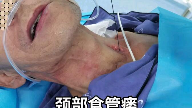 气管食管瘘-哔哩哔哩