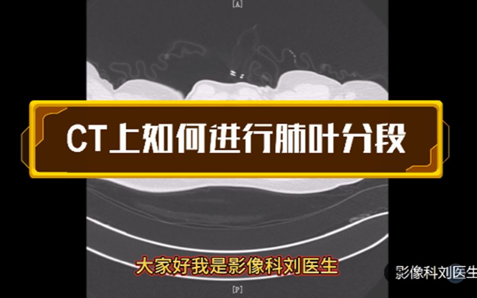 CT上如何准确进行肺叶分段?放射科医生讲解,简单易懂哔哩哔哩bilibili