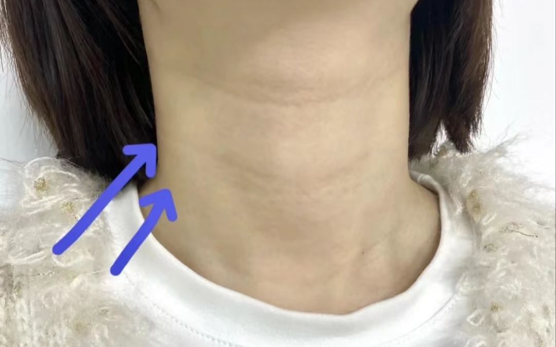 热点资讯:失眠突眼脖子大,得了甲亢不要怕,小方法解决大问题!