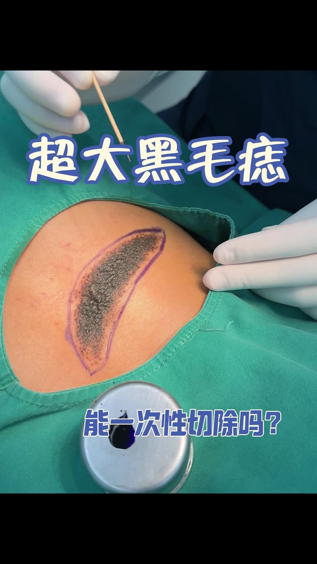 背部超大黑毛痣,能否一次性切除?
