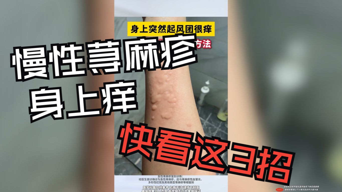 慢性荨麻疹,起红疙瘩,看这3招!哔哩哔哩bilibili