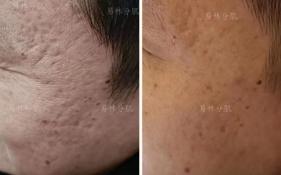 痘坑修复对比图