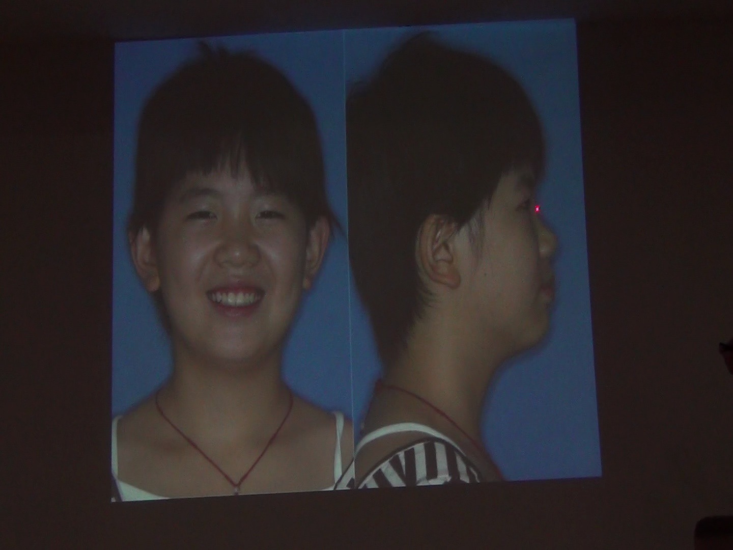 山东大学口腔医院吕涛教授 吕涛讲x线头影测量病例分析case2