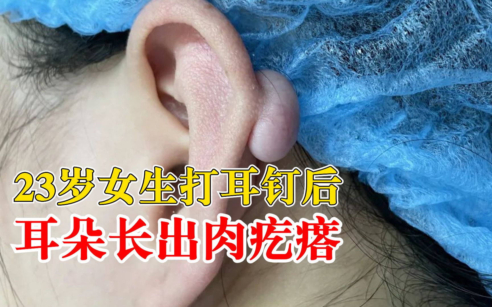 23岁女生打耳洞后耳朵长出肉疙瘩:为瘢痕疙瘩,需手术和放疗哔哩哔哩bilibili