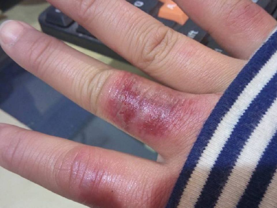 冻疮一直反复无法断根,多半是方法不对!看看过来人都是咋做的!