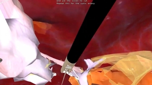 3d医学动画 腹腔镜胆囊切除 中英双字幕 原版英文 哔哩哔哩 つロ干杯 Bilibili