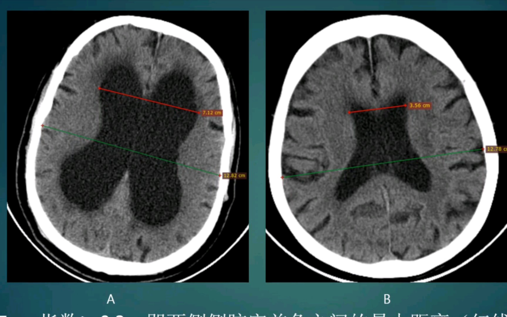 [图]正常压力性脑积水，易与脑萎缩混淆，它们的质量方法不一样，切勿误诊！