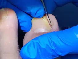 ✅ 精准修剪扎肉指甲，保留健康甲床，✅ 专业技师手法轻柔，不硬撬不硬拔，痛感极低