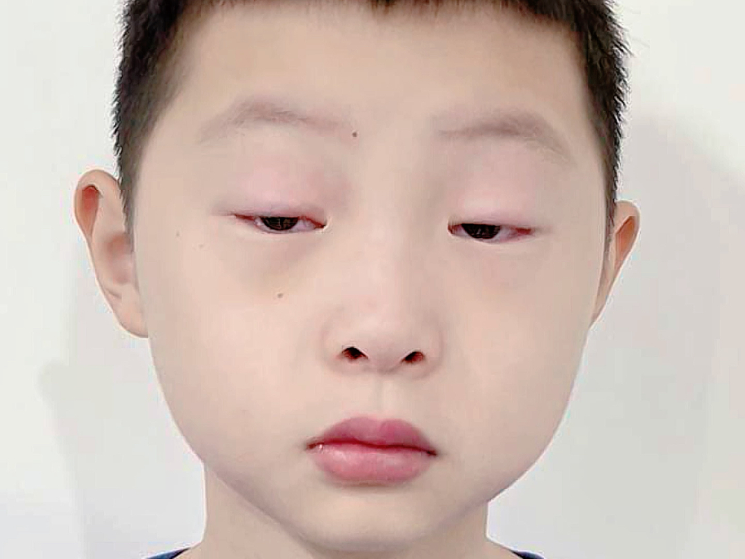 拯救先天上睑下垂