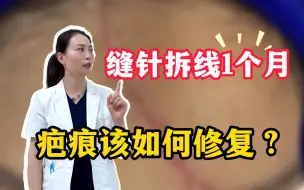 Download Video: 额头缝针拆线1个月，疤痕该如何修复呢？