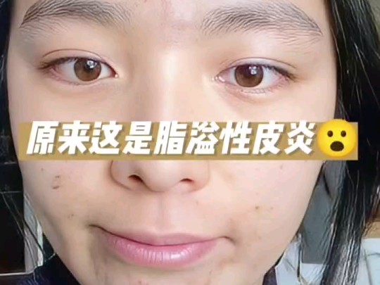 惊呆了!脸上痘痘原来是脂溢性皮炎引起的