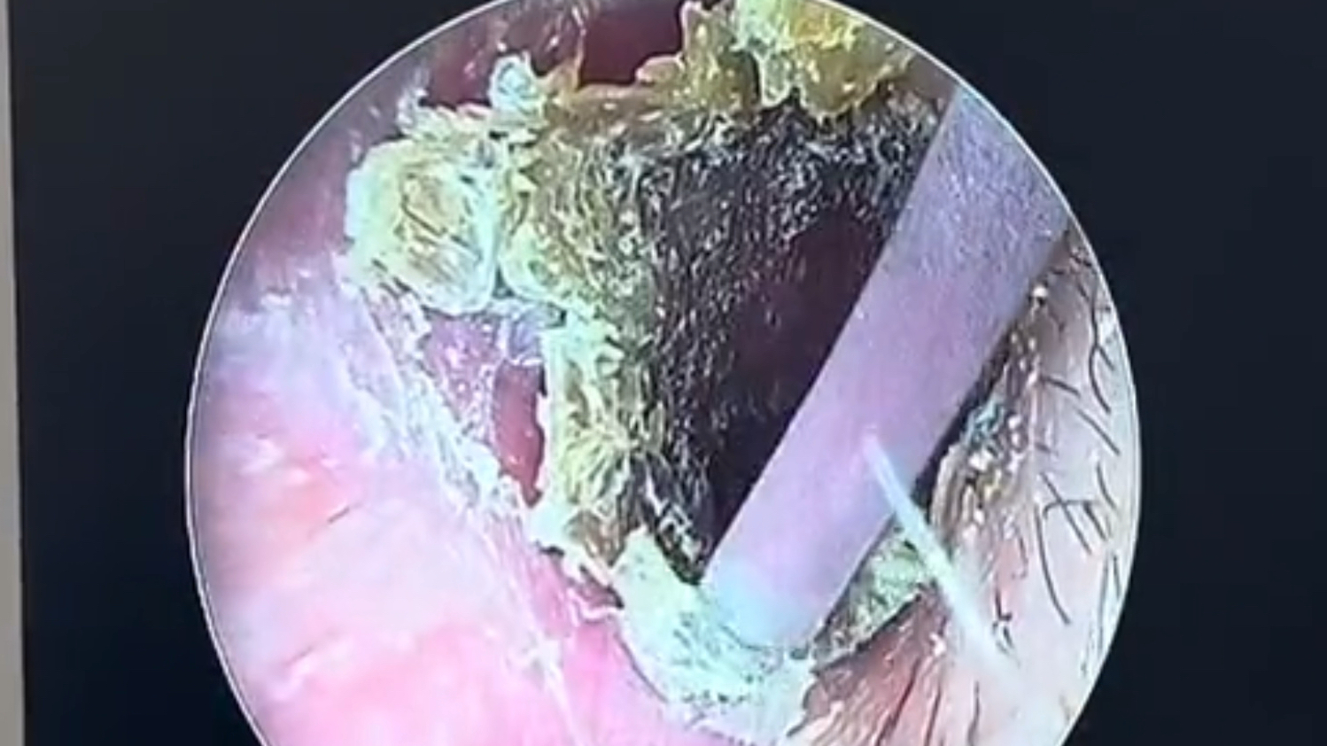 采耳解压;耳朵里好厚一层霉菌厚干片
