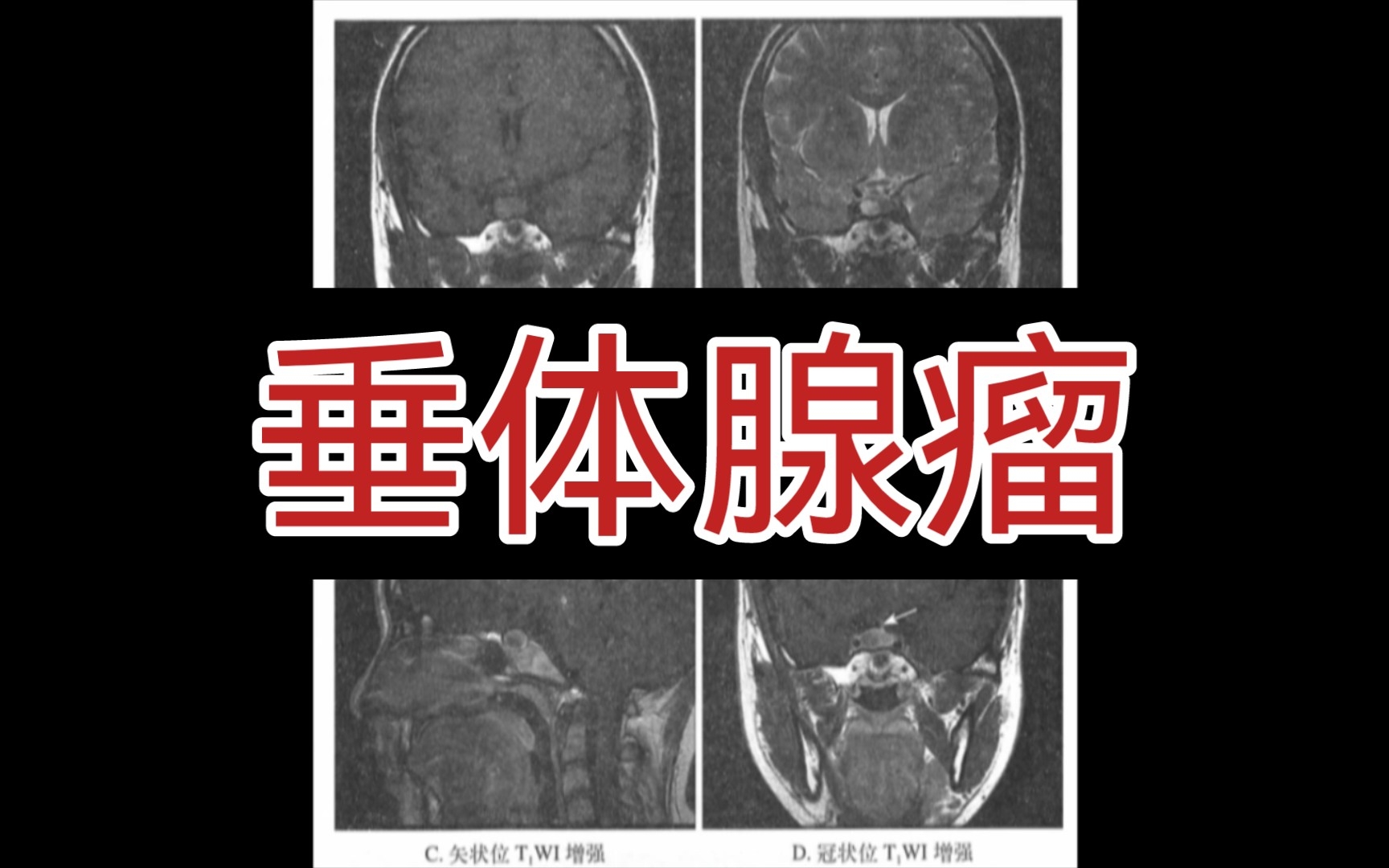 【医学影像】跟我一起刷病例 | 垂体瘤哔哩哔哩bilibili