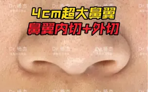 Скачать видео: 这个小姐姐初鼻有着4厘米超大鼻翼，来看看缩小后的样子吧