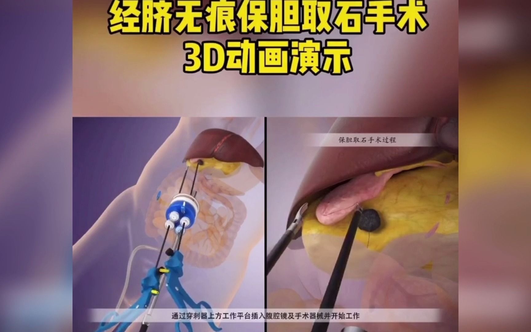 经脐无痕保胆取胆结石手术,看完是不是很治愈!