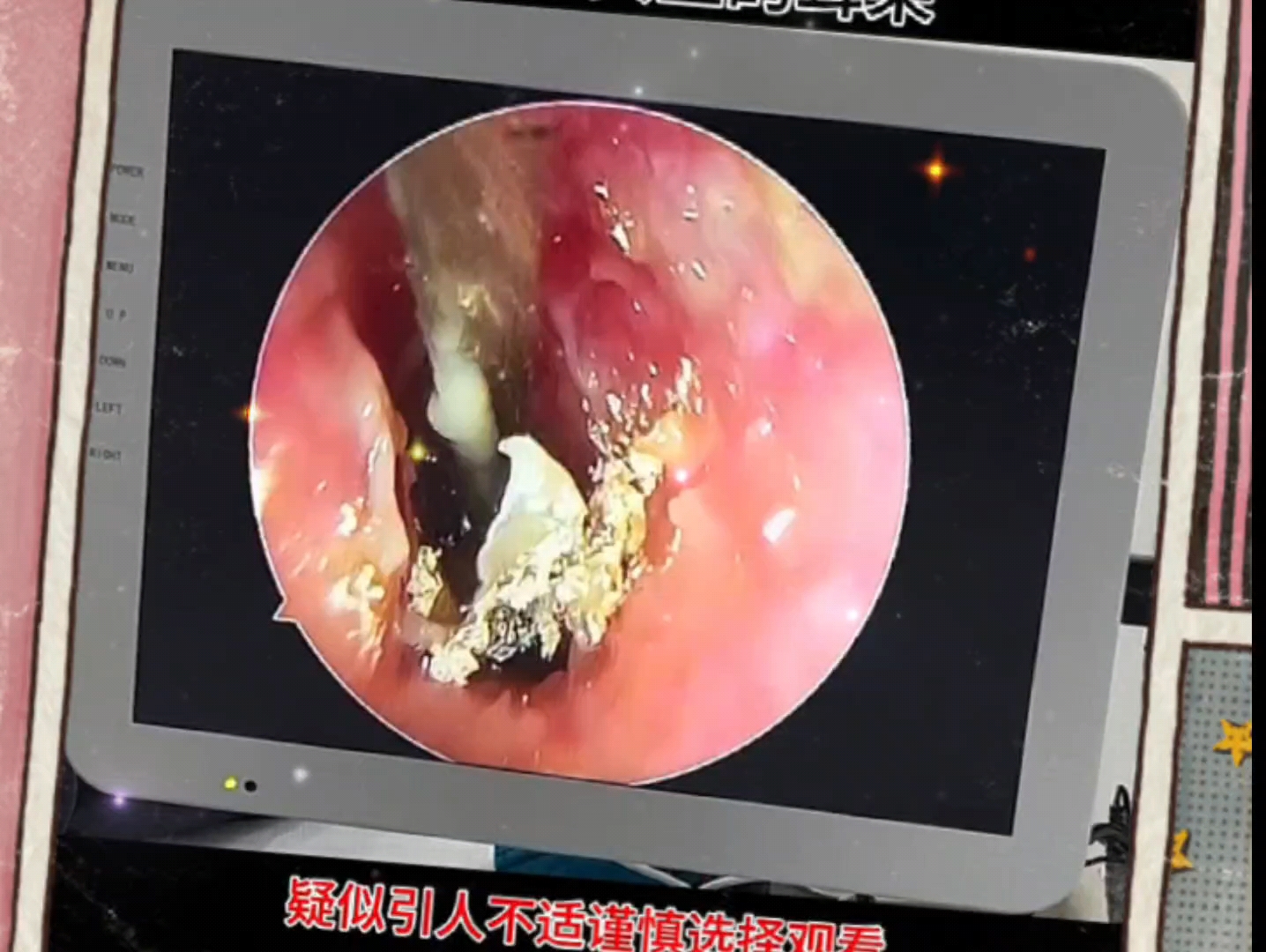 掏耳朵,这得多久没清理了都有虫卵了