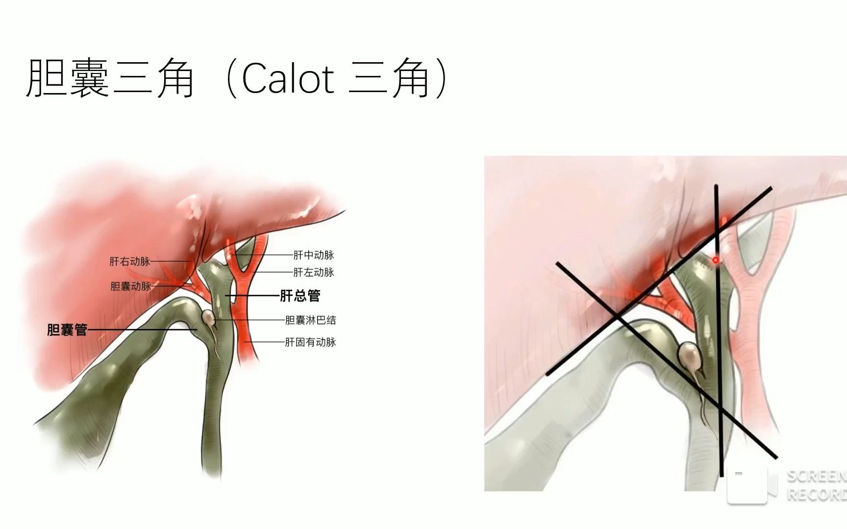 胆囊三角解剖哔哩哔哩bilibili