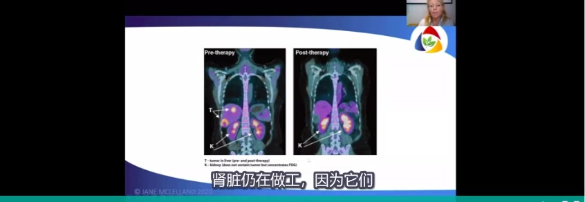 如何饿死癌症第二十一课——了解癌细胞特殊的有氧糖酵解代谢(瓦尔堡效应)哔哩哔哩bilibili