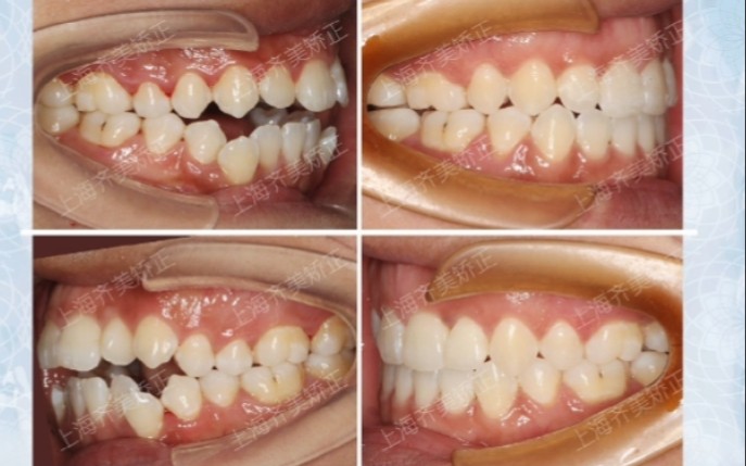 不是不爱吃,是牙齿大开合,根本吃不了6015