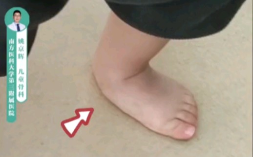 表现为重度扁平足的垂直距骨又称为"摇椅足" 如果被当做扁平足来治