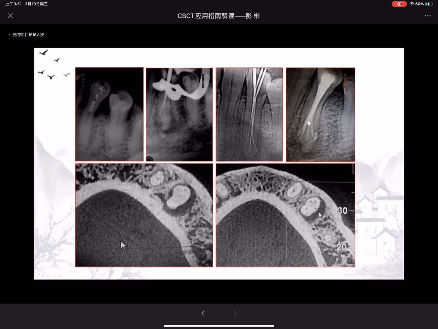 CBCT在根管治疗中的应用——口腔根管治疗彭彬系列课哔哩哔哩bilibili