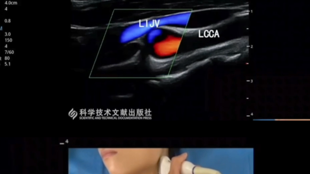 颈内静脉超声检查,超声引导颈内静脉穿刺哔哩哔哩bilibili