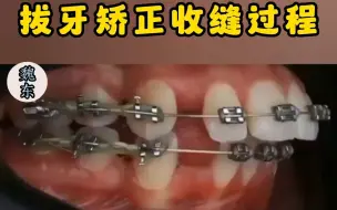 Tải video: 拔牙矫正收缝过程